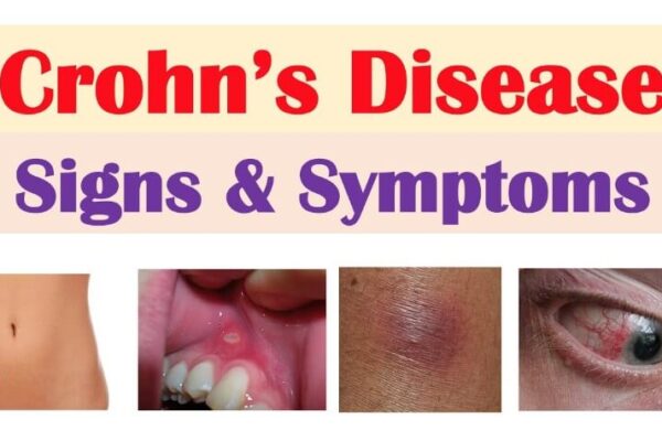 Crohn's Disease Symptoms