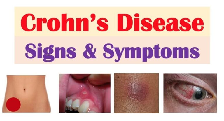 Crohn's Disease Symptoms