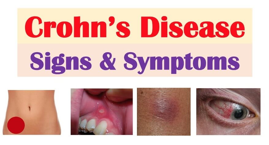 Crohn's Disease Symptoms
