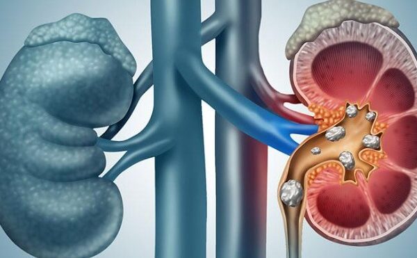 Kidney Stones