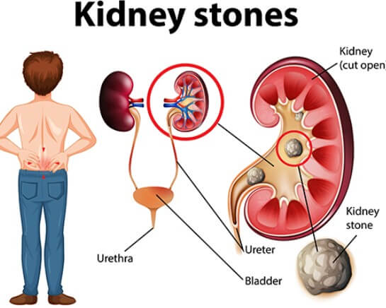 kidney stones