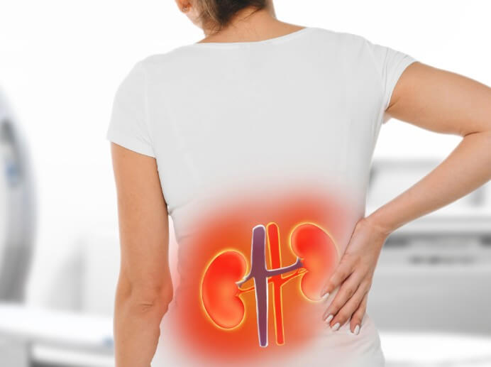 kidney stones