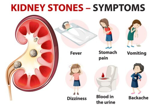kidney stones